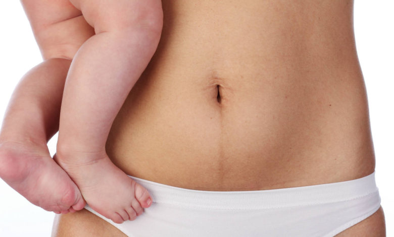 كيفية التخلص من تشققات البطن: 11 طريقة منزلية لعلاج التشققات بعد الولادة