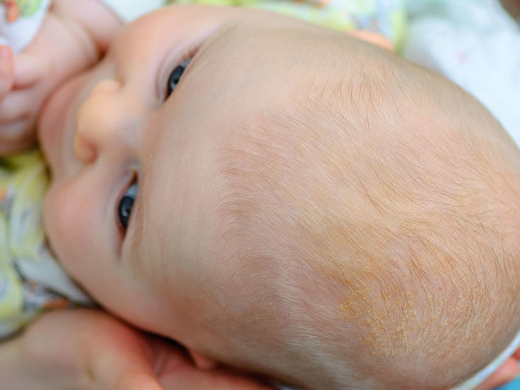 لماذا تنمو قشرة الرأس لدى حديثي الولادة؟